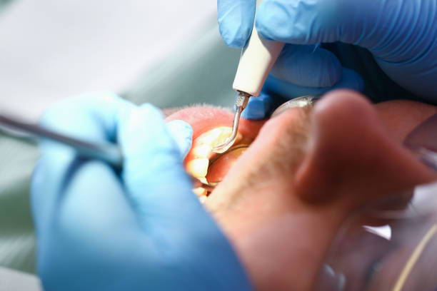 Best Emergency Wisdom Teeth Removal in Catawba, SC